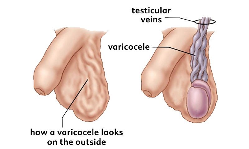 Varicocele 