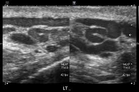 Ultrasound of varicocele
